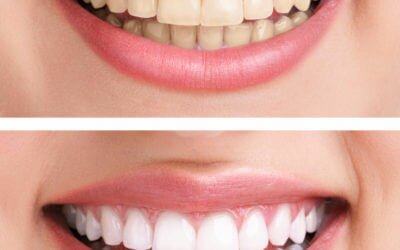 5 Teeth-Whitening Myths Busted!